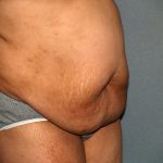 Tummy Tuck Before & After Patient #1969