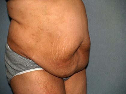 Tummy Tuck Before & After Patient #1969