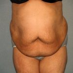 Tummy Tuck Before & After Patient #1969