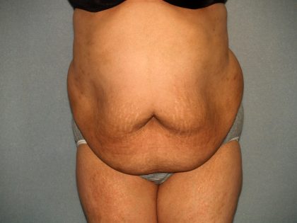 Tummy Tuck Before & After Patient #1969