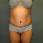 Tummy Tuck Before & After Patient #1969