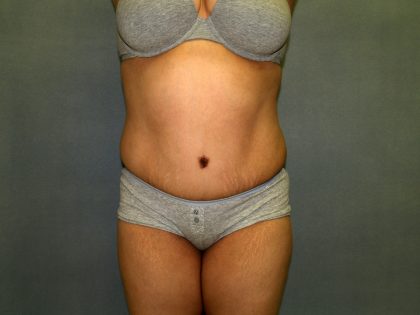 Tummy Tuck Before & After Patient #1969