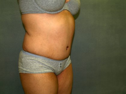 Tummy Tuck Before & After Patient #1969