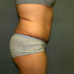 Tummy Tuck Before & After Patient #1969