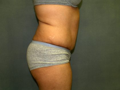 Tummy Tuck Before & After Patient #1969