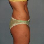 Tummy Tuck Before & After Patient #2403