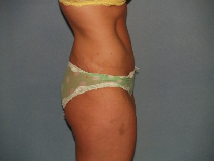 Tummy Tuck Before & After Patient #2403