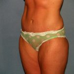 Tummy Tuck Before & After Patient #2403