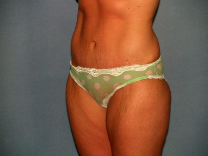 Tummy Tuck Before & After Patient #2403