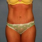 Tummy Tuck Before & After Patient #2403