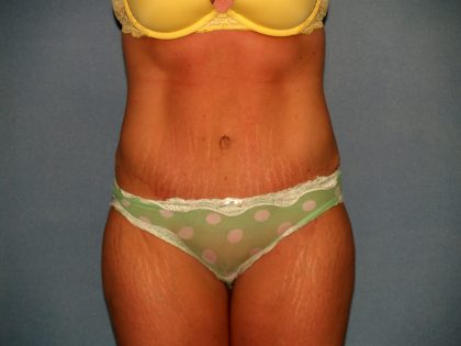 Tummy Tuck Before & After Patient #2403