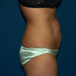 Tummy Tuck Before & After Patient #2403
