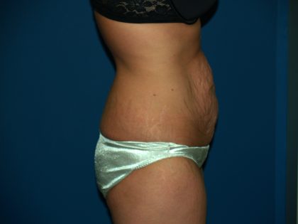 Tummy Tuck Before & After Patient #2403