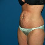 Tummy Tuck Before & After Patient #2403