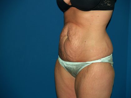 Tummy Tuck Before & After Patient #2403