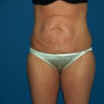 Tummy Tuck Before & After Patient #2403