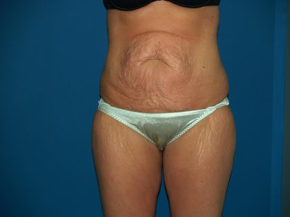 Tummy Tuck Before & After Patient #2403