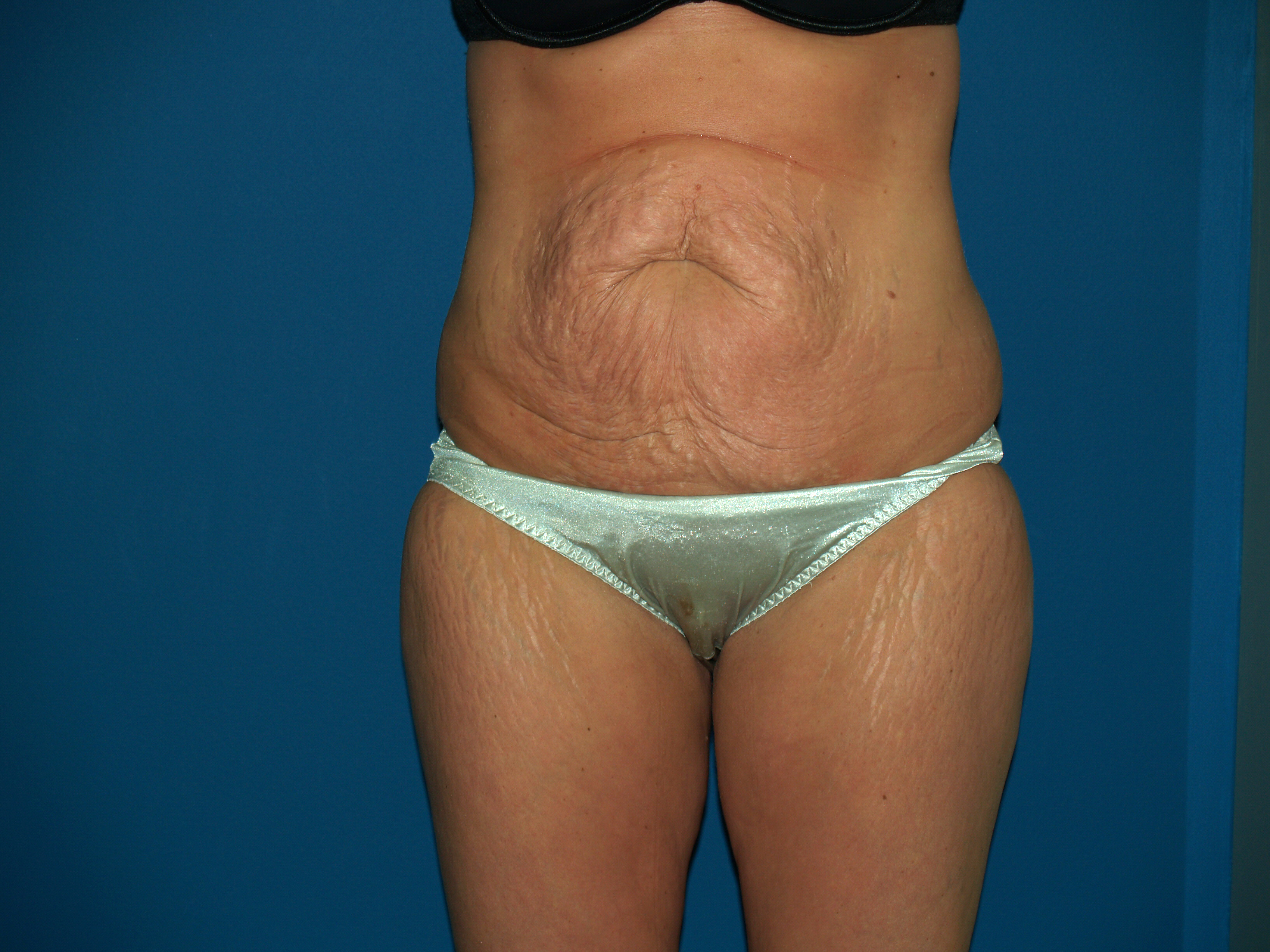 Tummy Tuck Before & After Patient #2403