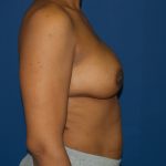 Breast Reconstruction Before & After Patient #2158