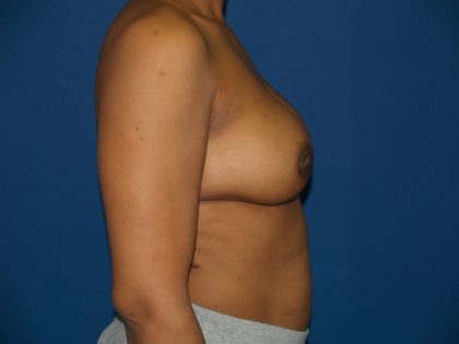 Breast Reconstruction Before & After Patient #2158