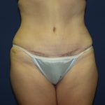 Tummy Tuck Before & After Patient #2095