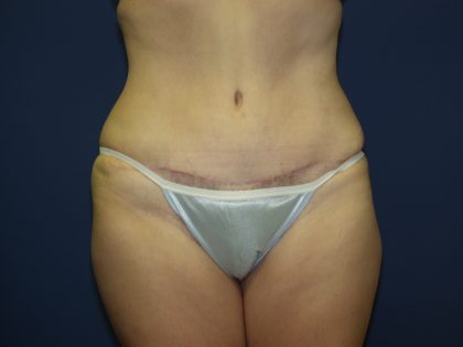Tummy Tuck Before & After Patient #2095