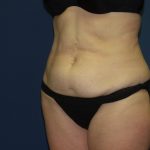 Tummy Tuck Before & After Patient #2095