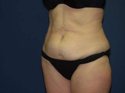 Tummy Tuck Before & After Patient #2095