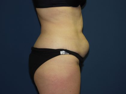 Tummy Tuck Before & After Patient #2095