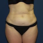 Tummy Tuck Before & After Patient #2095