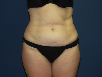 Tummy Tuck Before & After Patient #2095