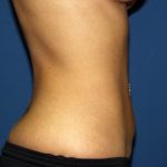 Liposuction Before & After Patient #3847