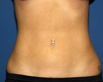 Liposuction Before & After Patient #3847