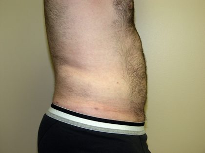 Liposuction Before & After Patient #3794