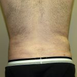 Liposuction Before & After Patient #3794