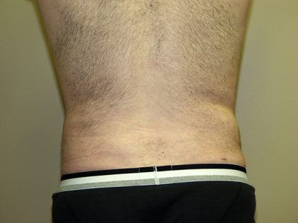 Liposuction Before & After Patient #3794