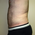 Liposuction Before & After Patient #3794