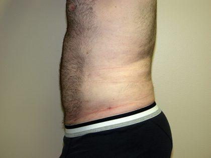 Liposuction Before & After Patient #3794