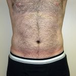 Liposuction Before & After Patient #3794