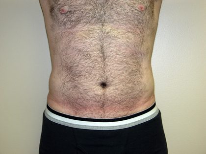 Liposuction Before & After Patient #3794