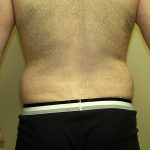 Liposuction Before & After Patient #3794