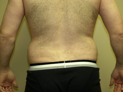 Liposuction Before & After Patient #3794