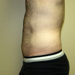 Liposuction Before & After Patient #3794