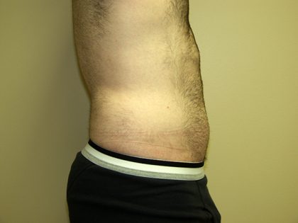 Liposuction Before & After Patient #3794