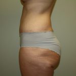 Tummy Tuck Before & After Patient #2135