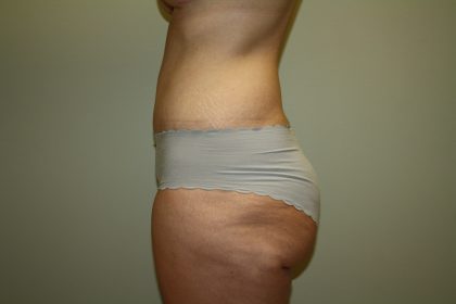 Tummy Tuck Before & After Patient #2135