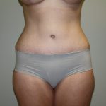 Tummy Tuck Before & After Patient #2135