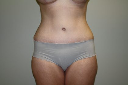 Tummy Tuck Before & After Patient #2135