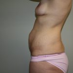 Tummy Tuck Before & After Patient #2135