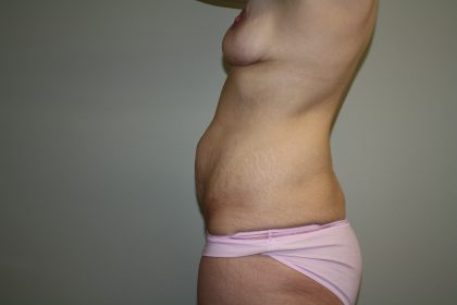 Tummy Tuck Before & After Patient #2135